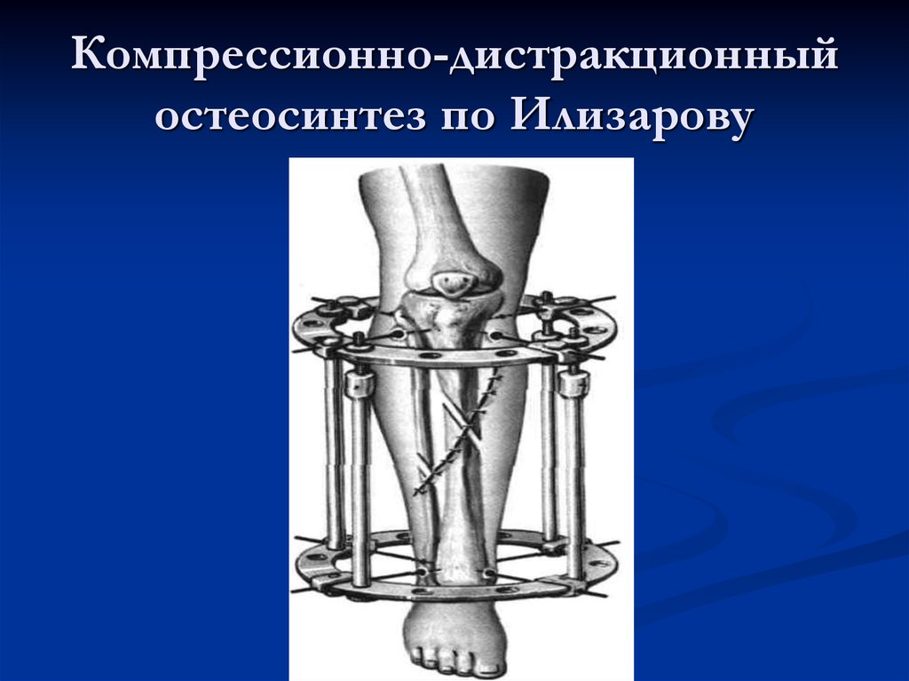 Операции на костях. Внеочаговый (компрессионно-дистракционный, чрескостный) остеосинтез. Чрескостный остеосинтез аппаратом Илизарова. Внеочаговый компрессионный остеосинтез. Внеочаговый остеосинтез аппаратом Илизарова.