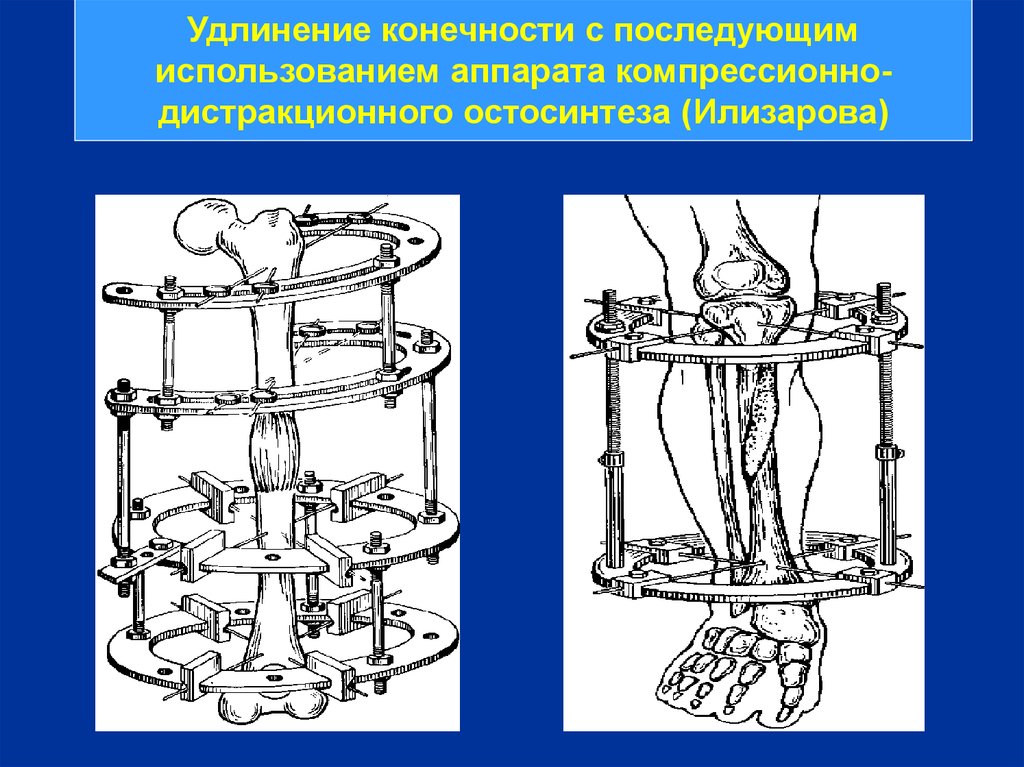 Операции на костях. Компрессионно-дистракционный аппарат Илизарова. Аппарат Илизарова удлинение конечности. Аппарат Илизарова удлинение костей. Компрессионно дистракционные аппараты Илизарова таз.
