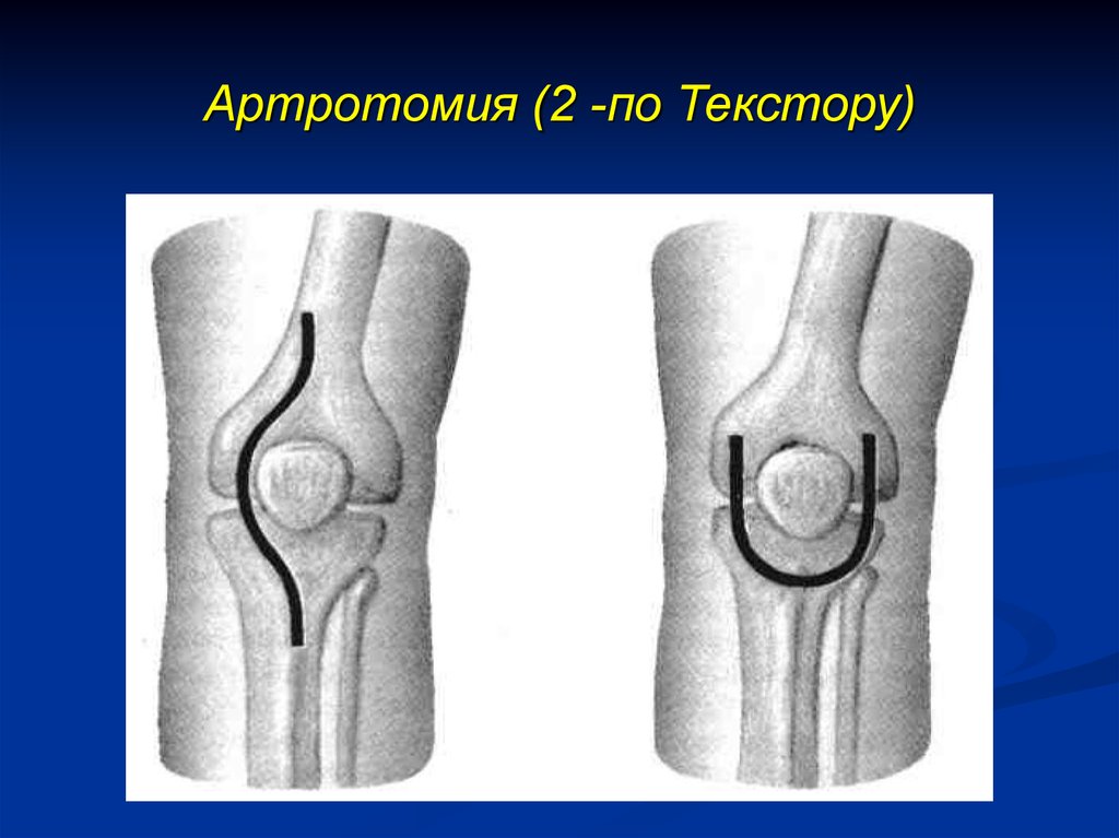 Операции на костях. Парапателлярная артротомия коленного сустава. Артранемия коленного сустава. Пункция, артротомия и резекция коленного сустава. Паракондилярная артротомия коленного сустава.