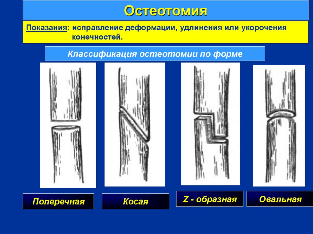 Способ удлинить. Виды остеотомии. Остеотомия классификация. Поперечная остеотомия. Операции на костях. Остеотомия.