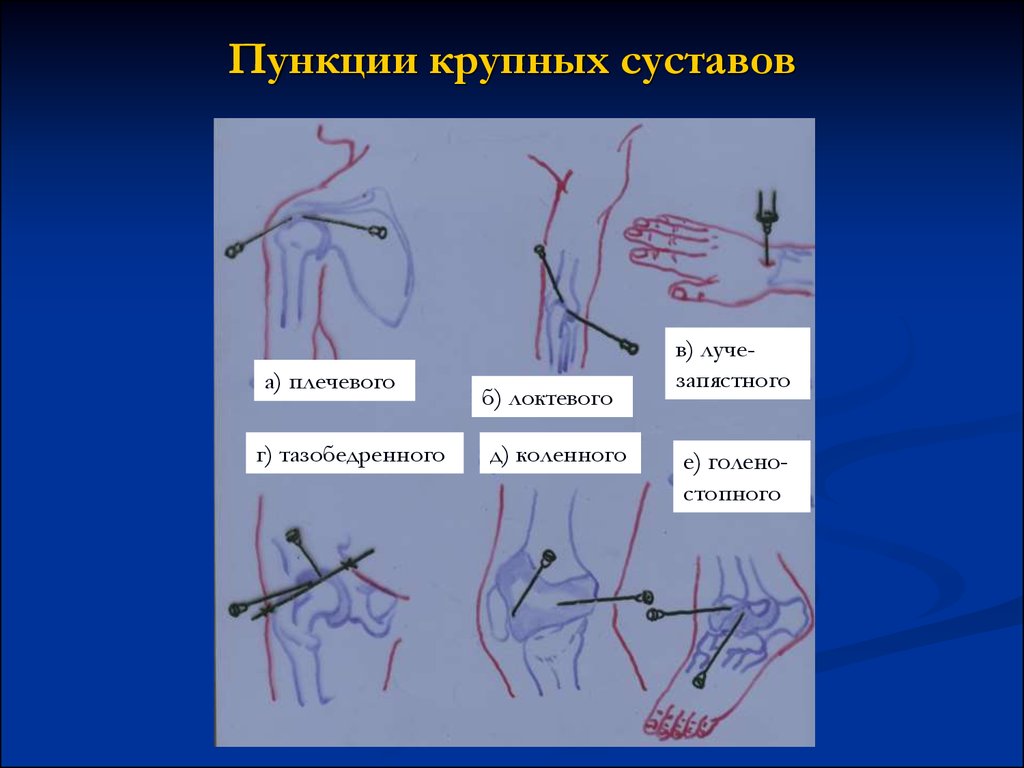 Пункция плечевого сустава. Пункция плечевого сустава топографическая. Пункция верхней конечностей. Пункция плечевого сустава техника. Пункция плечевого сустава спереди.