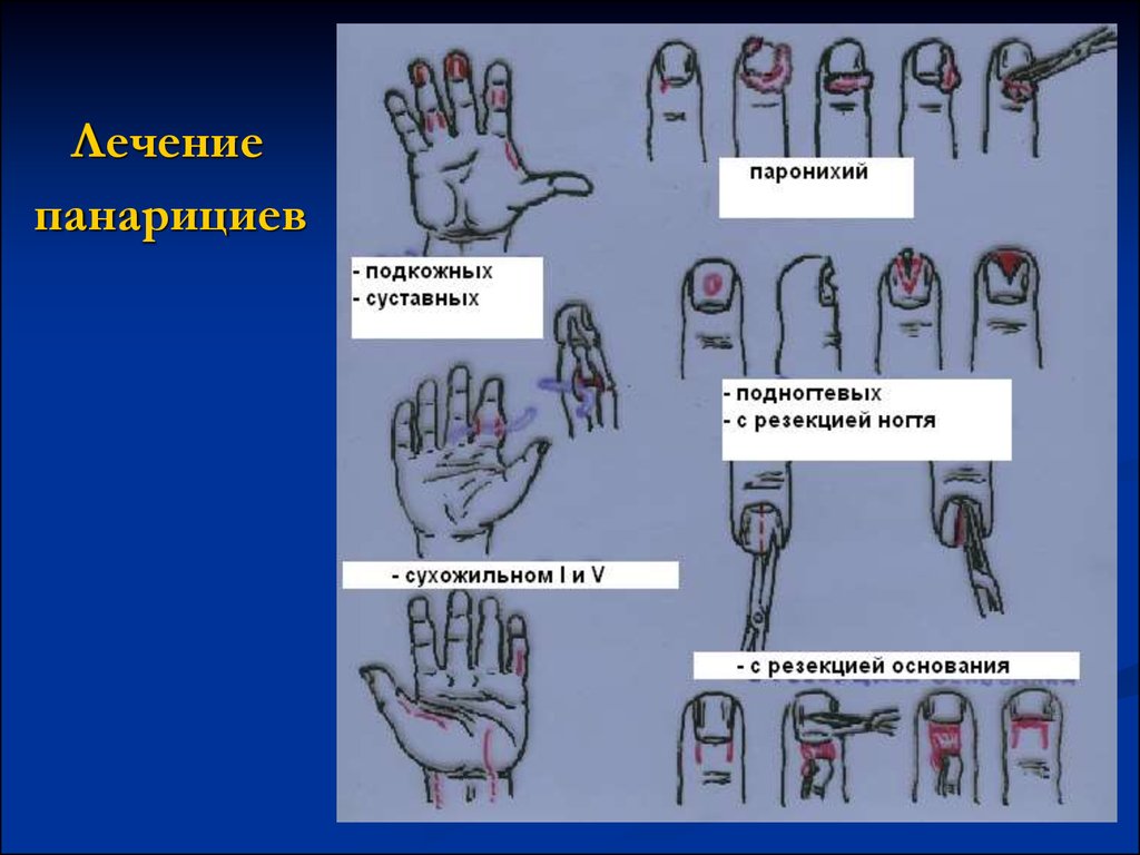 Лечение панариция. Панариций: принципы хирургического лечения.. Классификация панарициев хирургия. Вскрытие подногтевого панариция.