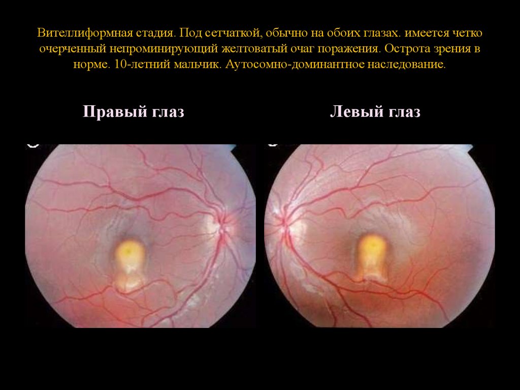 Вителлиформная стадия. Под сетчаткой, обычно на обоих глазах. имеется четко очерченный непроминирующий желтоватый очаг поражения. Острота