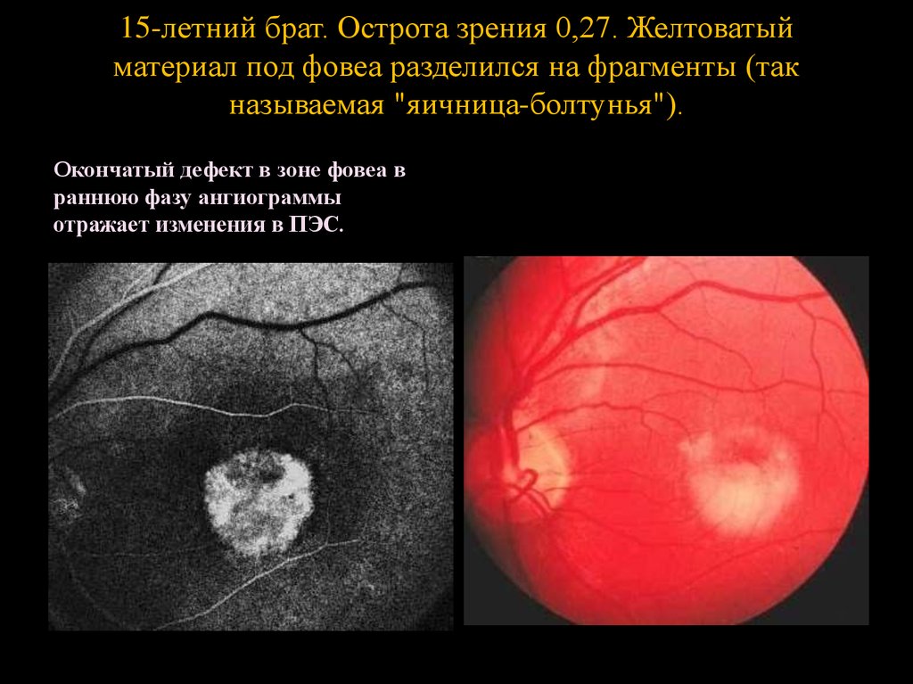 15-летний брат. Острота зрения 0,27. Желтоватый материал под фовеа разделился на фрагменты (так называемая "яичница-болтунья").