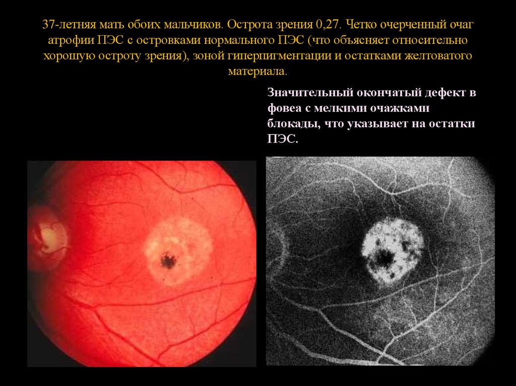 37-летняя мать обоих мальчиков. Острота зрения 0,27. Четко очерченный очаг атрофии ПЭС с островками нормального ПЭС (что объясняет относитель