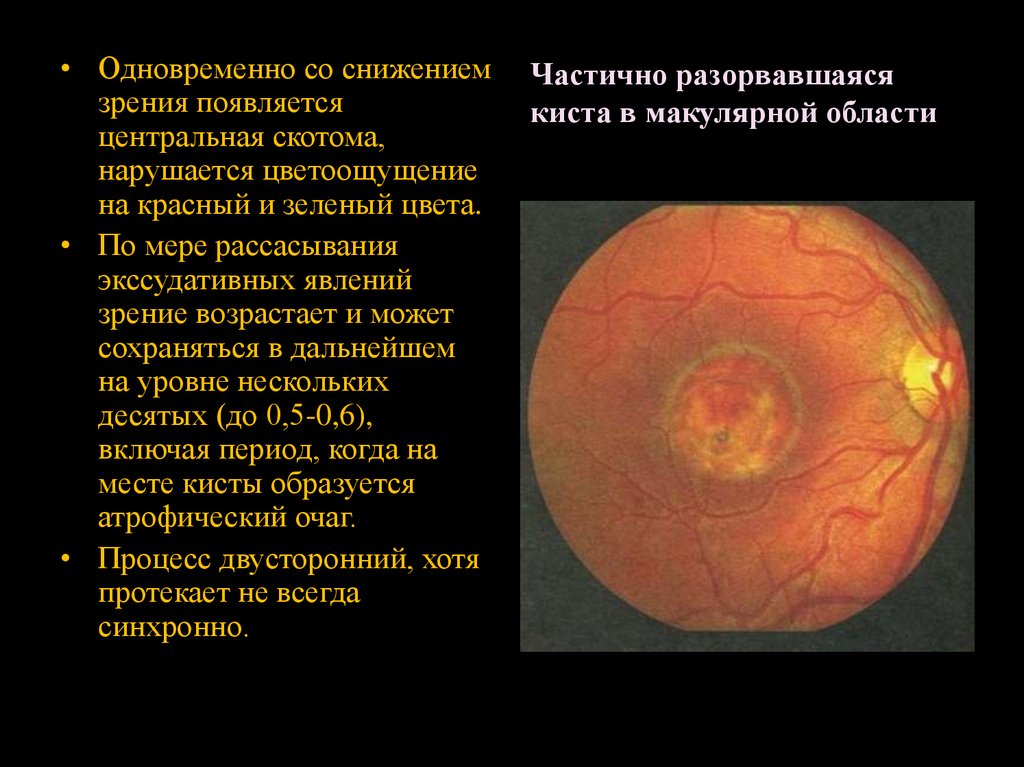 Дистрофия Беста - online presentation