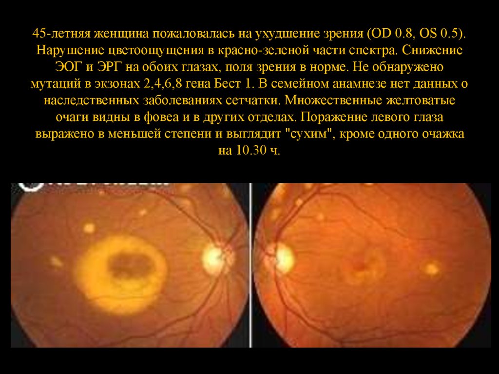 45-летняя женщина пожаловалась на ухудшение зрения (OD 0.8, OS 0.5). Нарушение цветоощущения в красно-зеленой части спектра. Снижение ЭОГ и ЭРГ на 