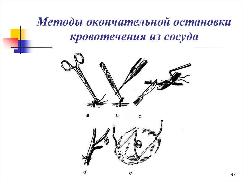 Методы остановки кровотечения презентация