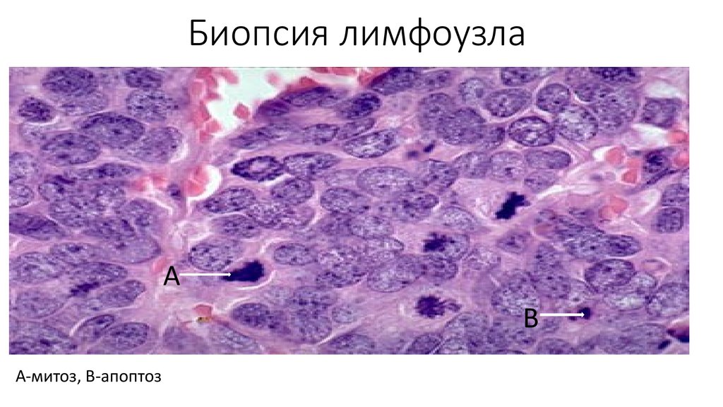 Биопсия лимфоузла. Прескаленная биопсия лимфоузла. Тонкоигольная биопсия лимфоузлов. Пункционная биопсия лимфатического узла. Эксцизионная биопсия лимфоузла.