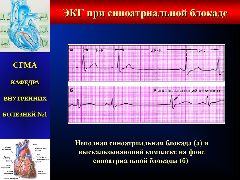 Синоатриальная блокада мкб