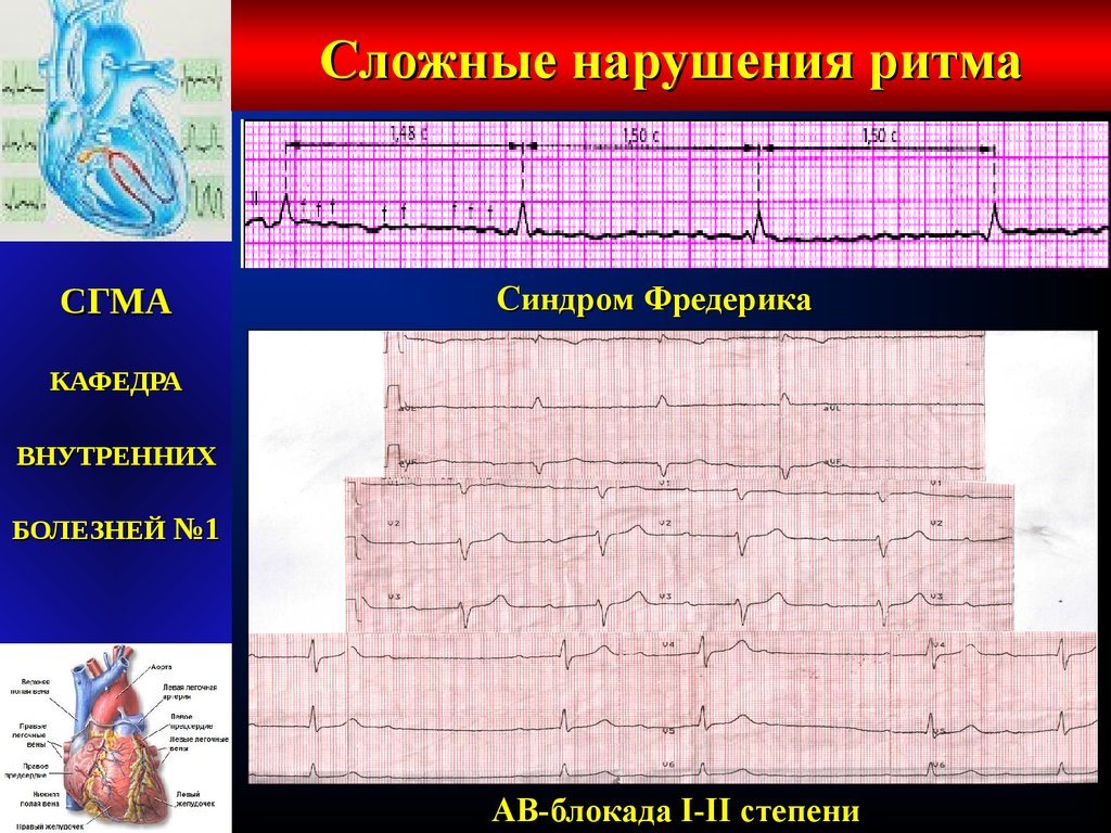 Сбой ритма