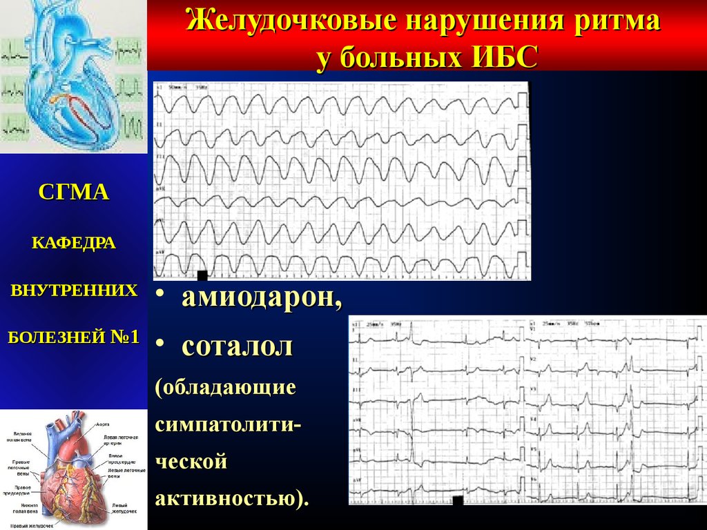 Желудочковый ритм