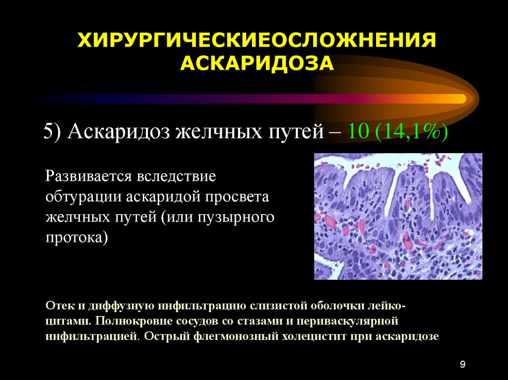 Метод диагностики аскаридоза