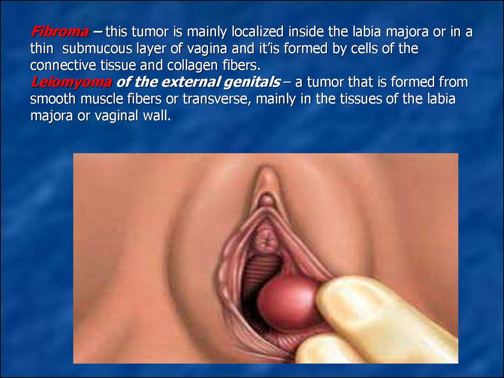 Vaginal Cyst