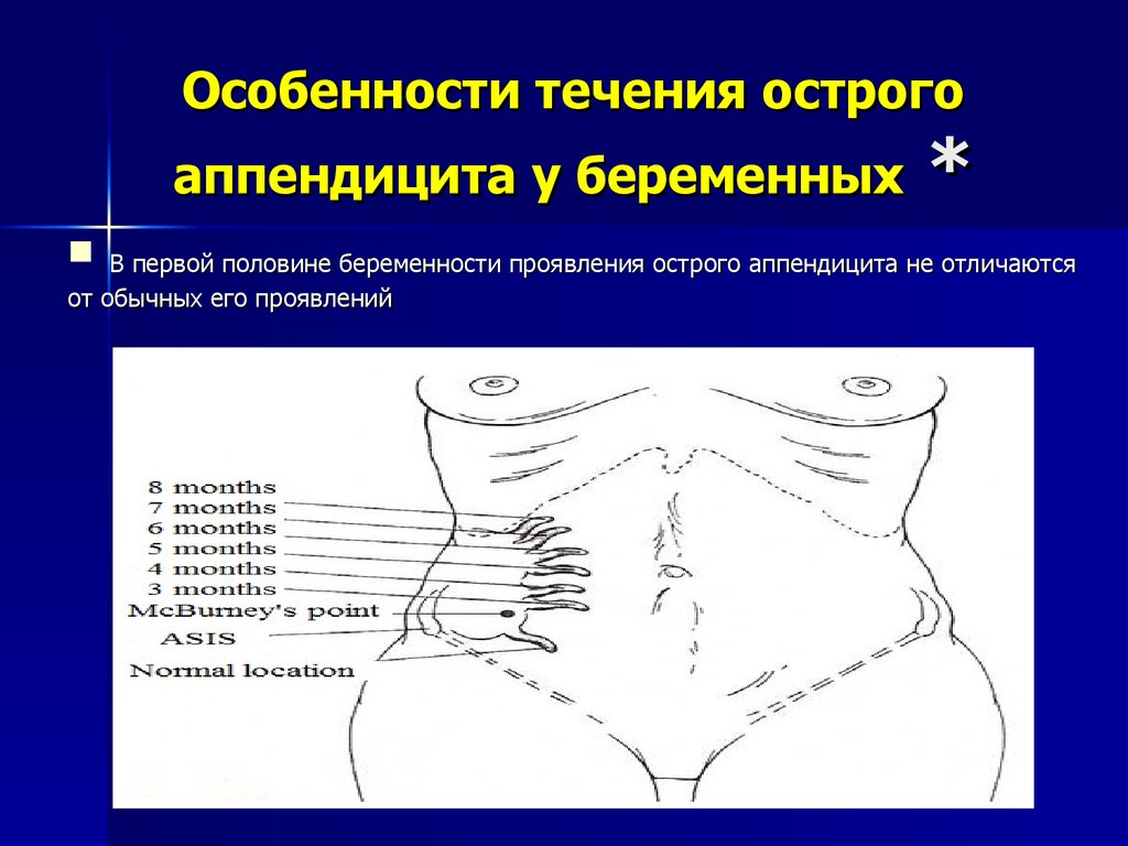 Презентация аппендицит и беременность