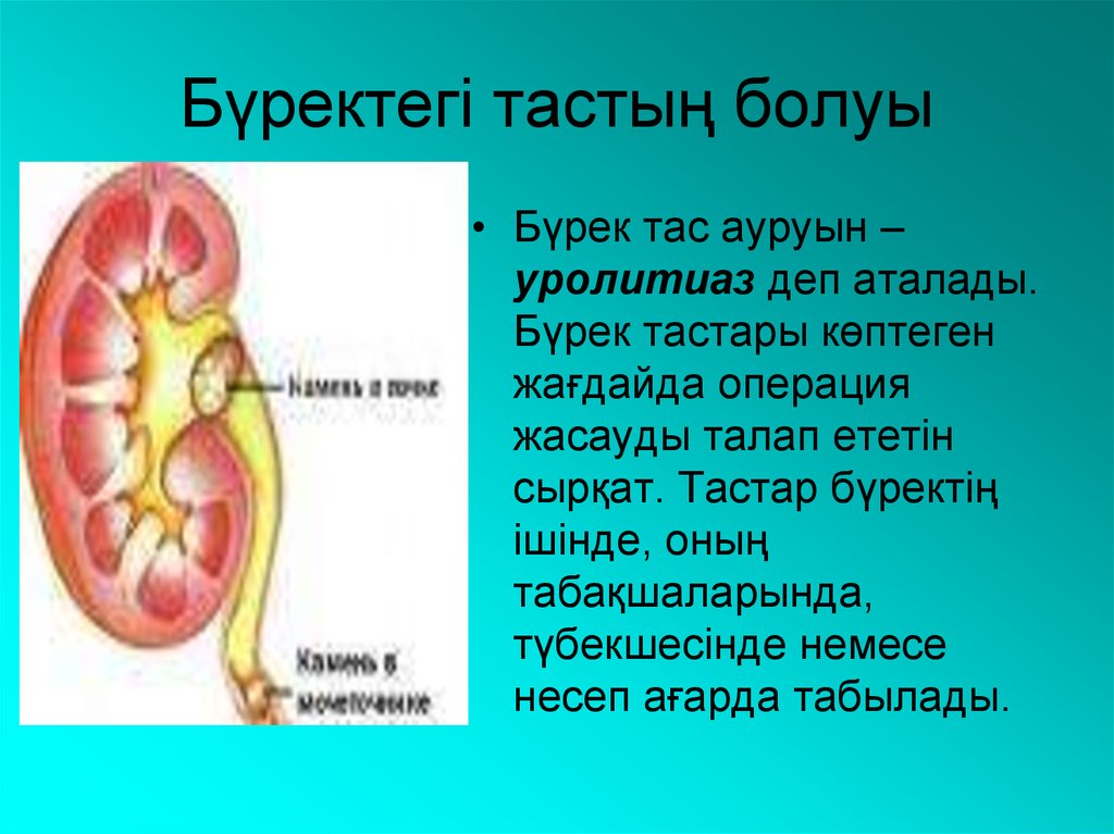 Бүректегі тастың болуы