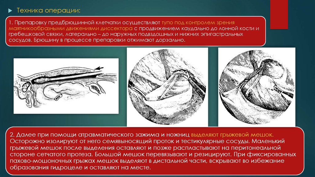 Техника операций. Лапароскопическая герниопластика пахово-мошоночная. Бурсооментоскопия техника операции.