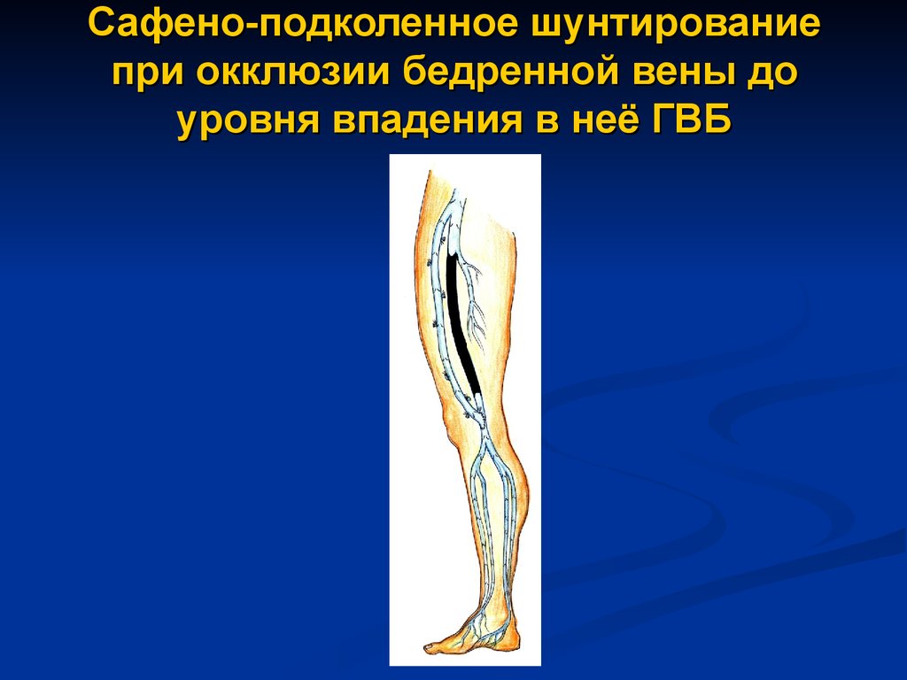 Подколенно бедренного. Подколенно-тибиальное шунтирование. Кроссэктомия операция Троянова Тренделенбурга. Бедренно-подколенное шунтирование кт. Бедренно подколенный шунт тромбоз.