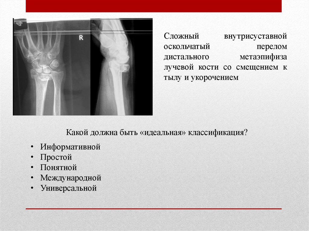 Оскольчатый перелом кости