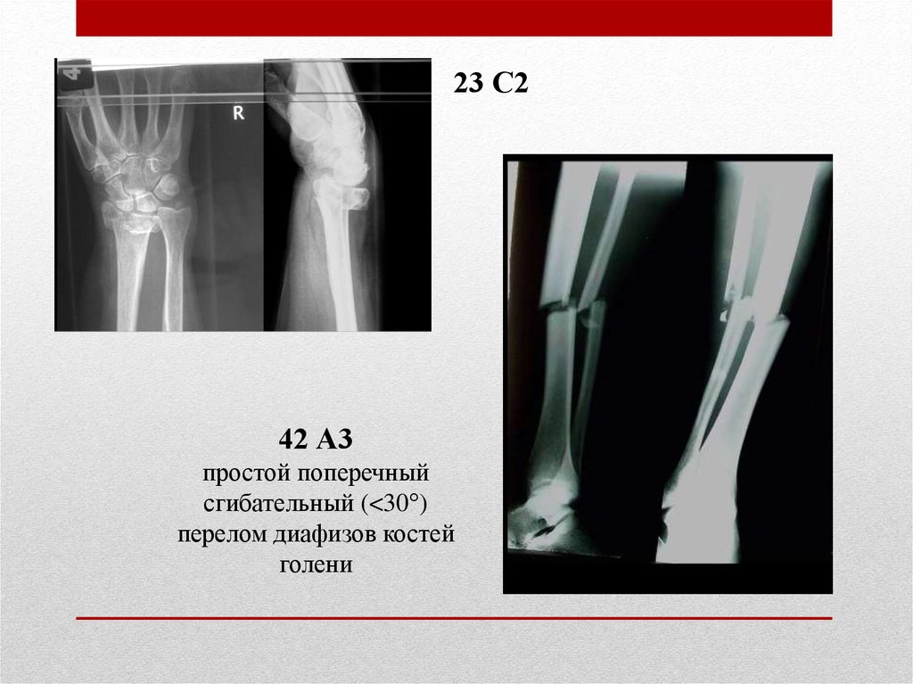 Диафизарные переломы костей голени презентация