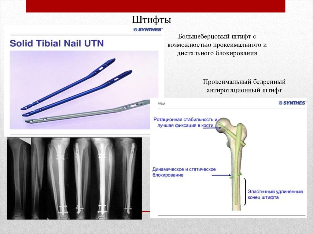 Штифт в травматологии фото