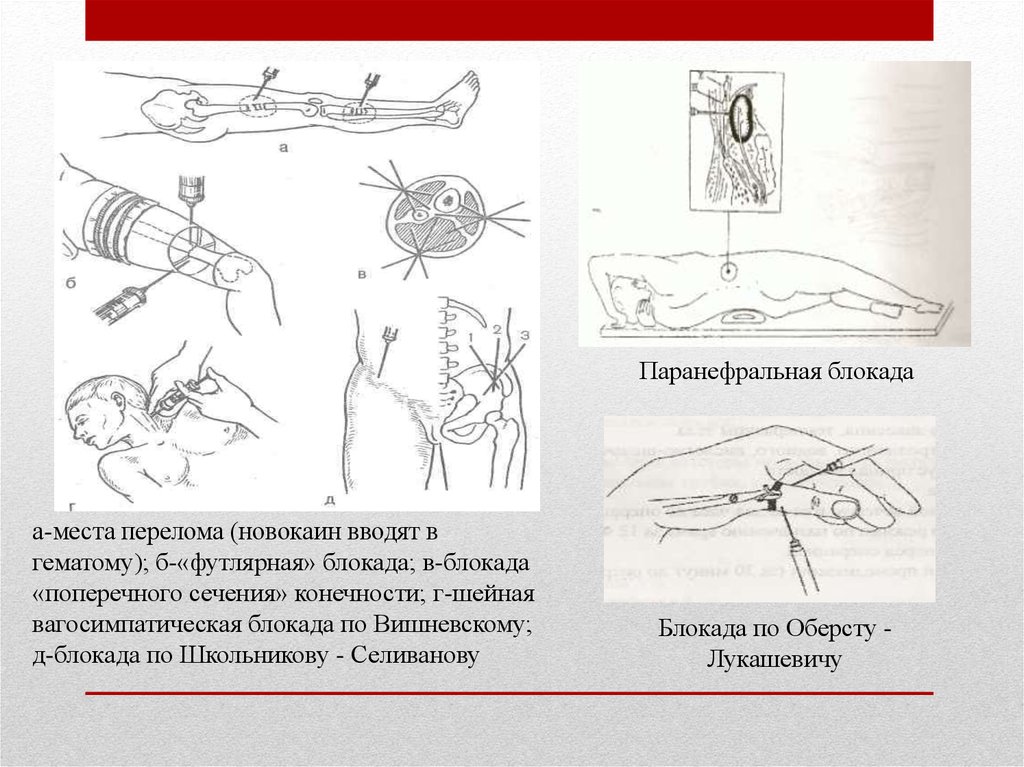 Вагосимпатическая по вишневскому