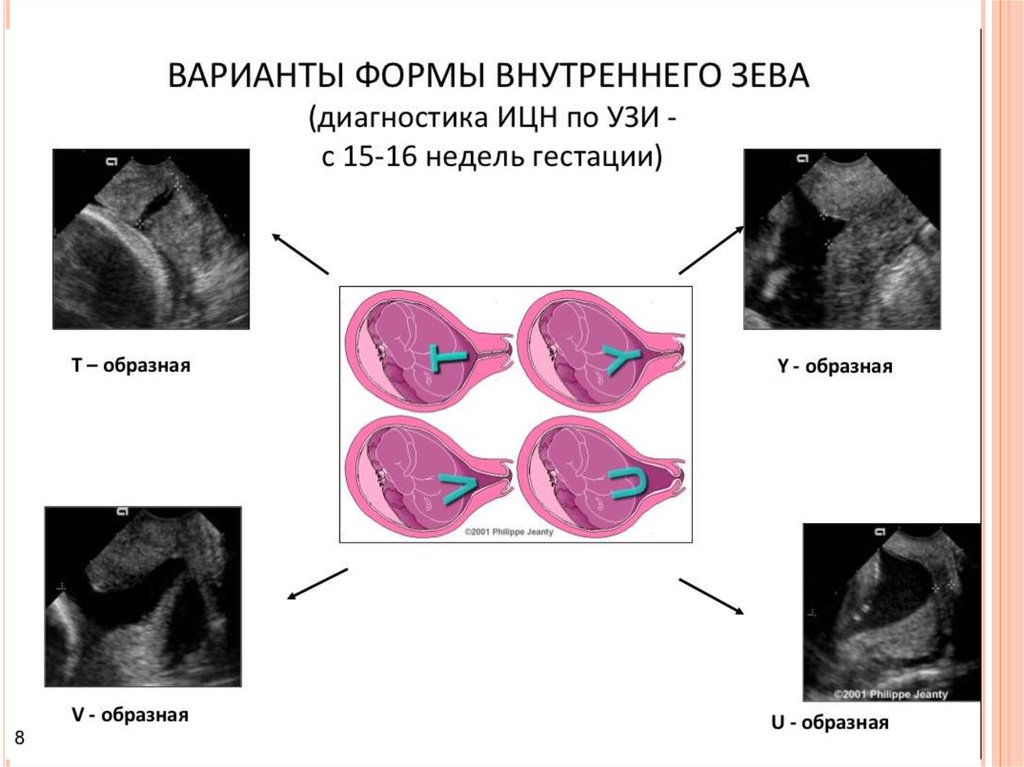 Что значит расширенная матка. Ультразвуковые критерии ИЦН. Критерии истмико цервикальной недостаточности по УЗИ. V образное расширение внутреннего зева шейки матки при беременности. Y образная форма внутреннего зева.