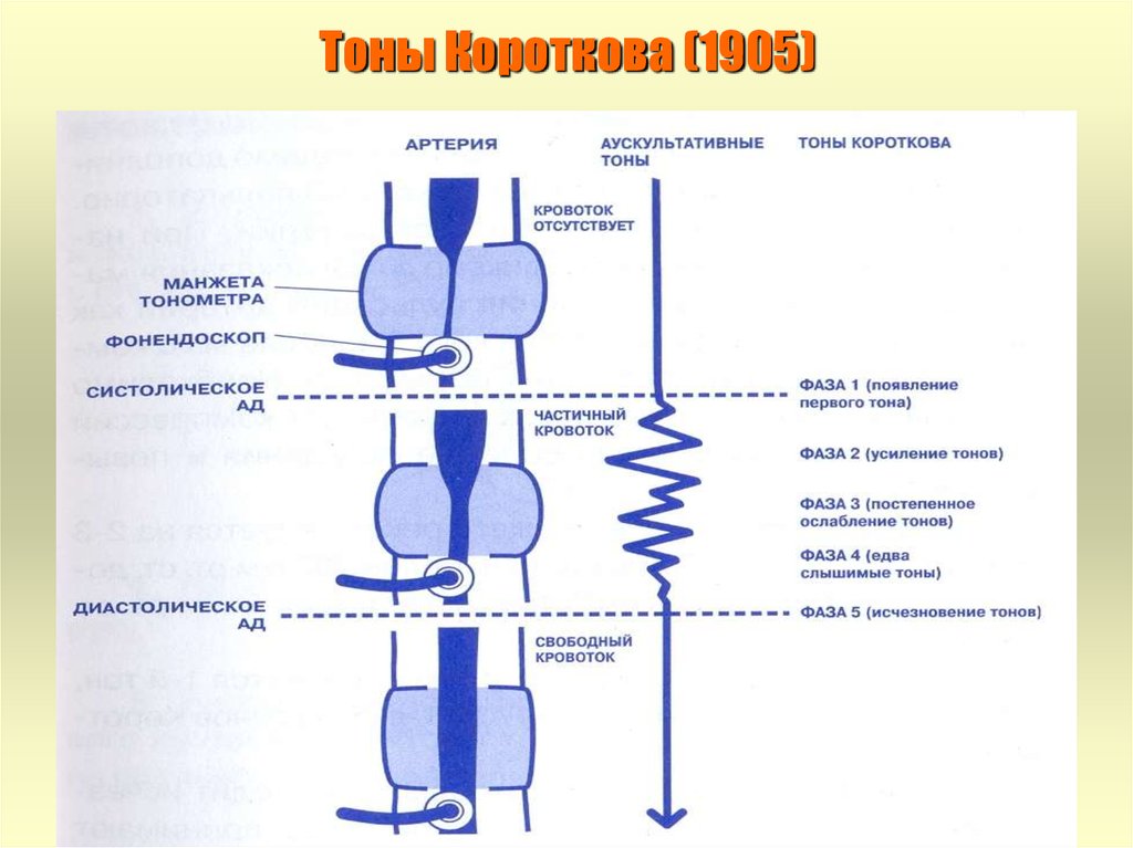 Тоны короткого. 5 Фаз тонов Короткова. Тоны Короткова измерение давления. Тоны Короткова методика. Методика измерения артериального давления по методу Короткова.