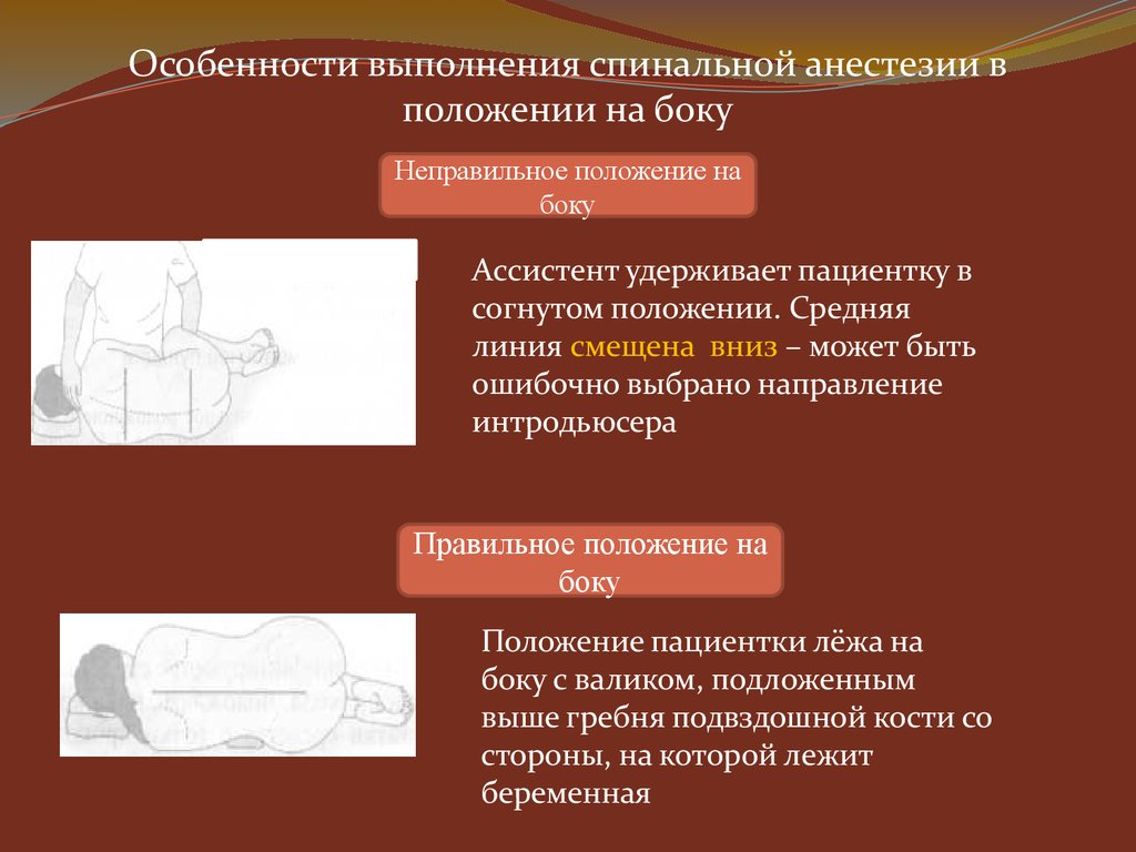 Спинальная анестезия. Особенности спинальной анестезии. Блок при спинальной анестезии. Высокий спинальный блок в анестезиологии. Сенсорный блок при спинальной анестезии.