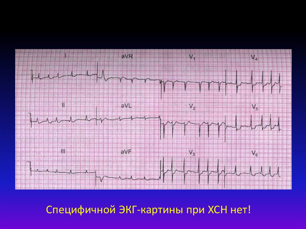экг при хронической сердечной недостаточности. на экг видно сердечную недостаточность. изменения на экг при сердечной недостаточности. экг при хроническом легочном сердце. дефект межжелудочковой перегородки экг.