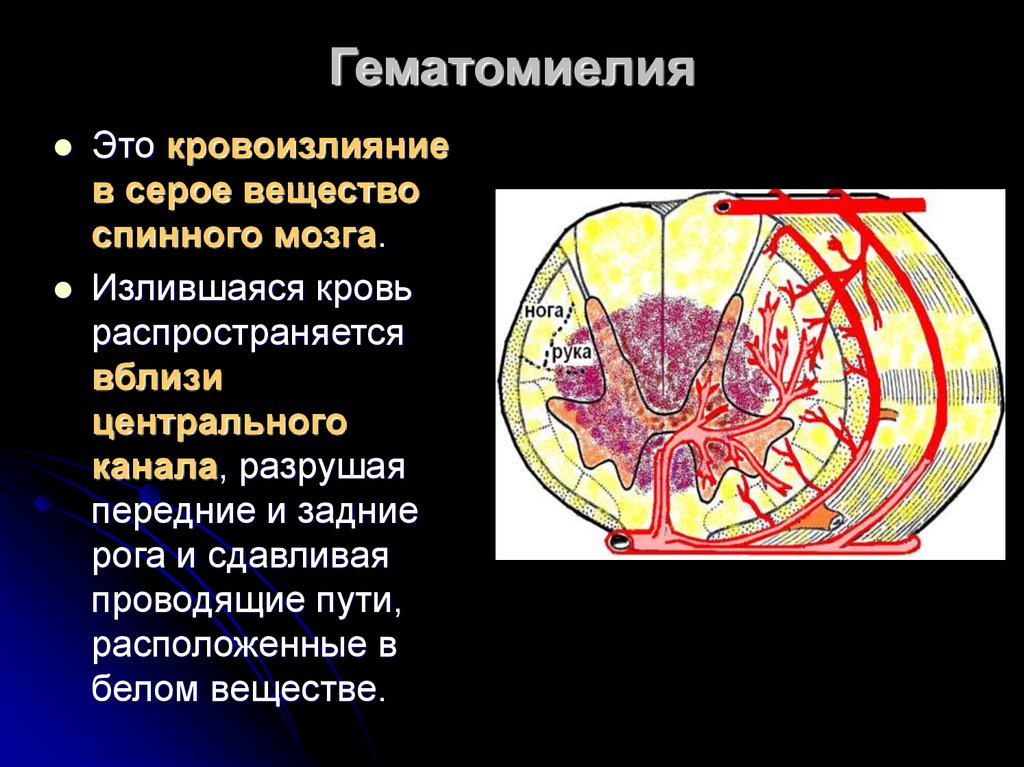 Спинальный инсульт лечение. Гематомиелия спинного мозга. Кровоизлияние в спинной мозг. Кровоизлияние в вещество спинного мозга. Кровоизлияние в передние рога спинного мозга.