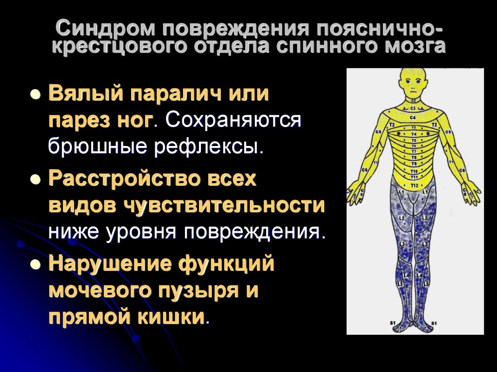 Повреждение спинного мозга. Травма поясничного отдела спинного мозга. Повреждение спинного мозга в поясничном отделе. Синдром поражения поясничного отдела спинного мозга. Синдром повреждения пояснично крестцового отдела спинного мозга.