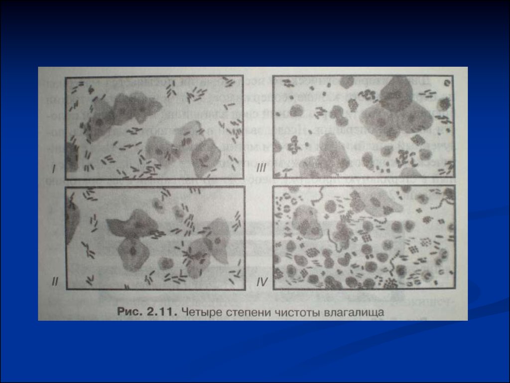 Четвертая стадия. Мазок гинекологический 4 степень чистоты. Степени чистоты влагалища. 4 Степени чистоты влагалища. Степень чистоты влагалища 4 степень.
