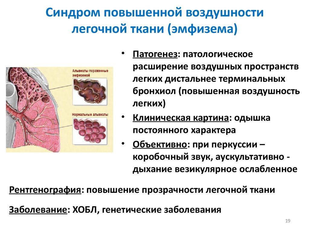 Эмфизема клиническая картина