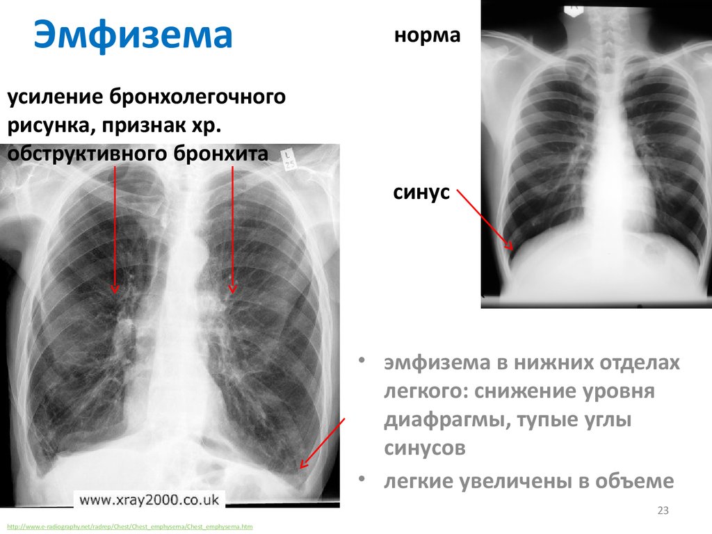 Сосудистый рисунок сглажен