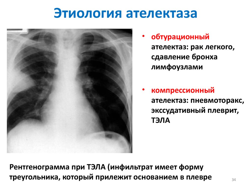 Пневмоторакс лучевая диагностика презентация