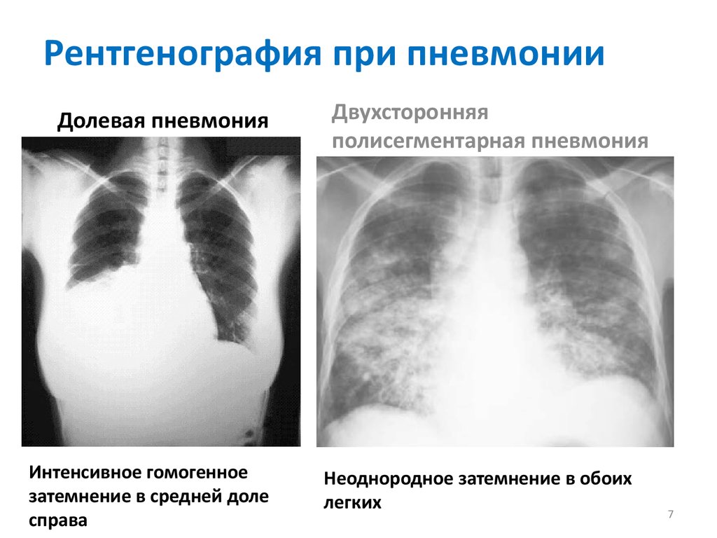 Двухсторонняя диффузная. Полисегментарная двухсторонняя пневмония рентген. Рентген при полисегментарной пневмонии. Двусторонняя нижнедолевая пневмония рентген. Полисегментарная пневмония рентген.