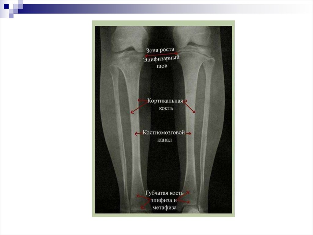 Зона роста кости. Зоны роста. Эпифизарные зоны роста. Зоны роста костей.
