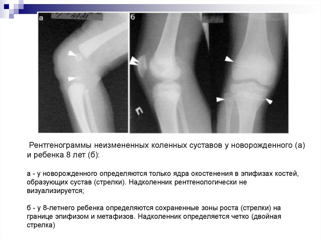 На рисунках представлены рентгенограммы суставов человека какой цифрой отмечена рентгенограмма