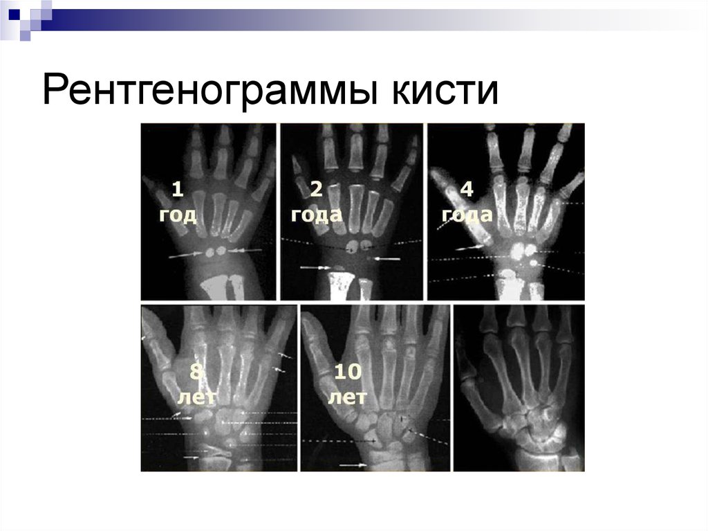 Костный возраст схема