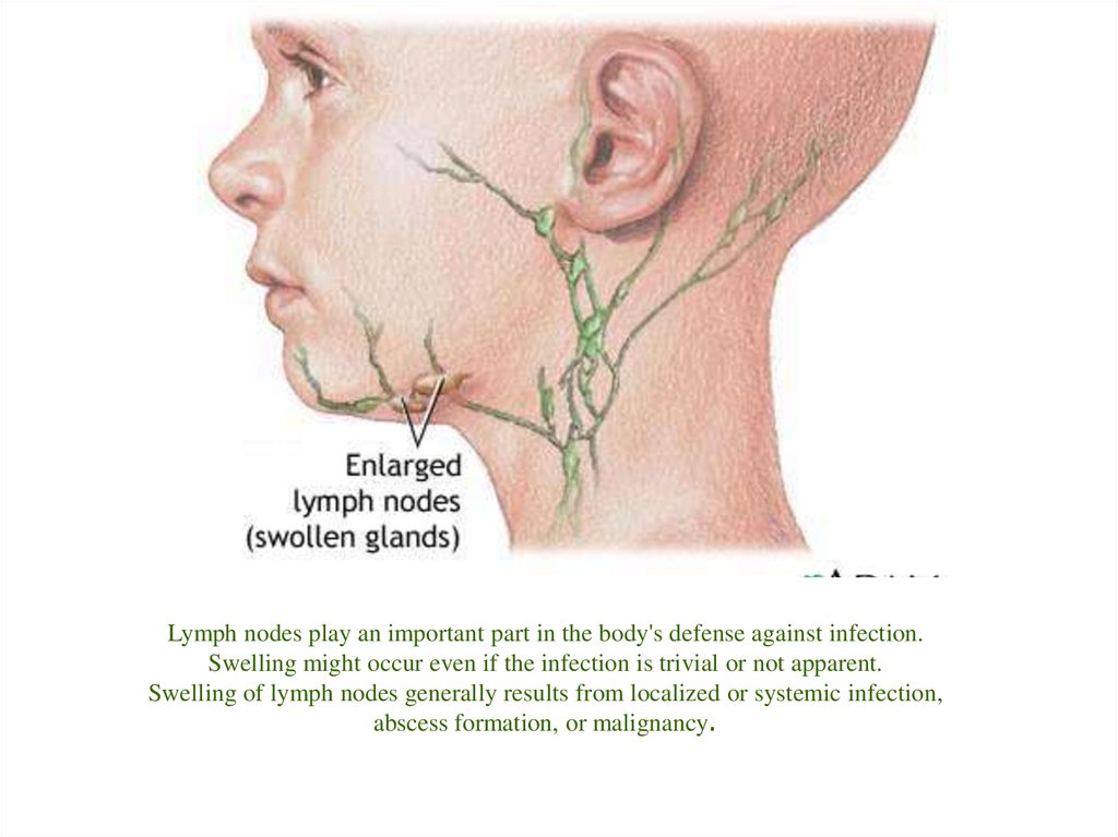 Лимфоузлы на шее что значит. Нижнечелюстные лимфоузлы расположение. Воспаление подчелюстных узлов. Воспаленные подключичные лимфоузлы. Воспаление подчелюстного лимфатического узла.