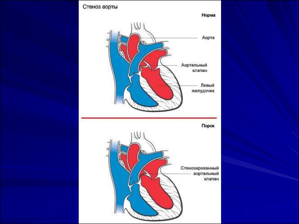 Стеноз устья аорты гемодинамика. Врожденный стеноз устья аорты. Изолированный аортальный стеноз. Изменения гемодинамики при стенозе устья аорты.