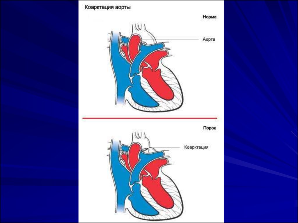 Оап у новорожденных. Врожденный порок сердца открытый артериальный проток. Открытый артериальный (боталлов) проток (ОАП). Врожденные пороки сердца ОАП.