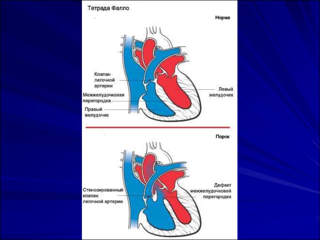 Врожденный порок сердца тетрада фалло презентация