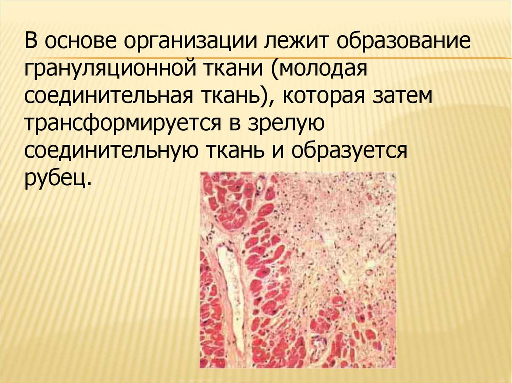 Грануляционная ткань