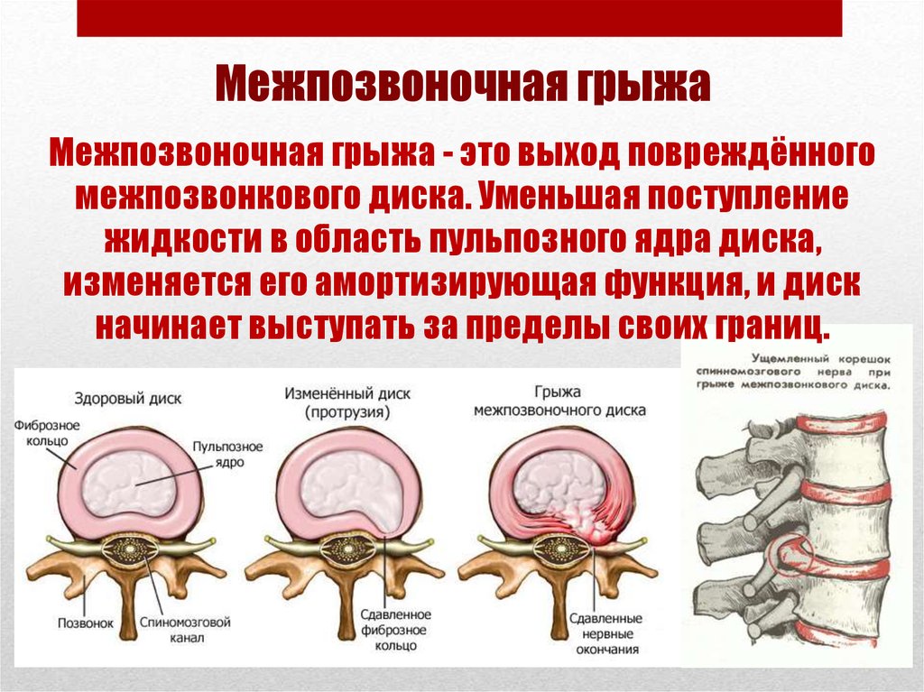 Грыжа межпозвонковых дисков презентация