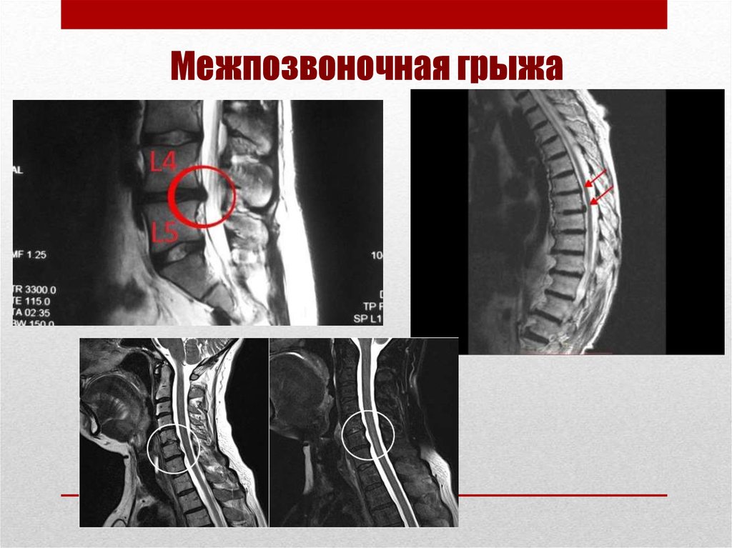 Межпозвоночная грыжа симптомы. Презентация грыжа позвоночника. Межпозвоночная грыжа симптомы и признаки. Лечение межпозвоночных грыж презентация.