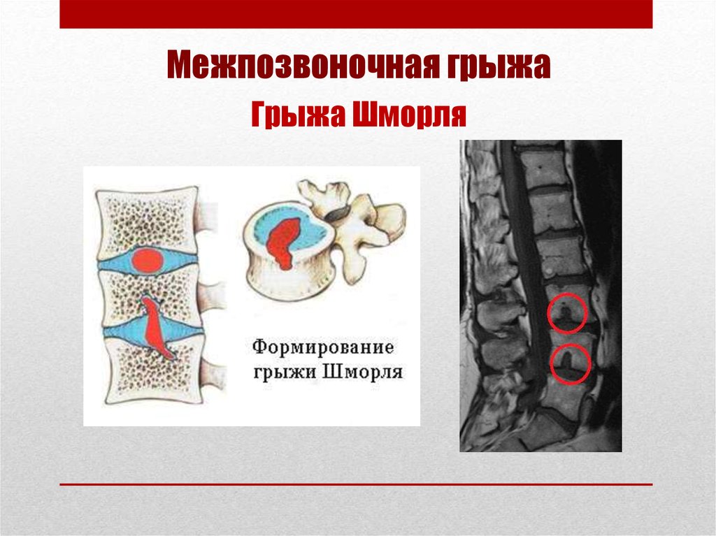 Множественные грыжи позвоночника. Единичная грыжа Шморля l2. L1 грыжа Шморля позвоночника. Th12-l1 позвонков грыжа Шморля.