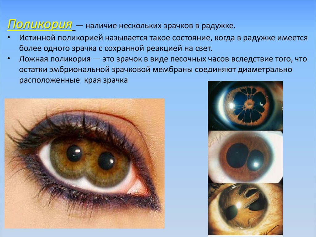 Зрение двумя глазами называют. Расширение зрачка на свет. Заболевания глаз зрачок.