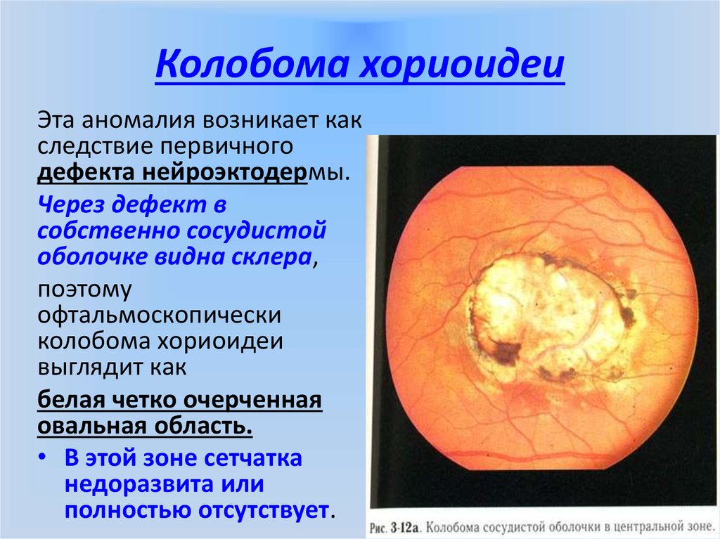 Заболевания сосудистой оболочки. Колобома хориоидеи глаза. Колобома диска зрительного нерва. Врожденная колобома хориоидеи.
